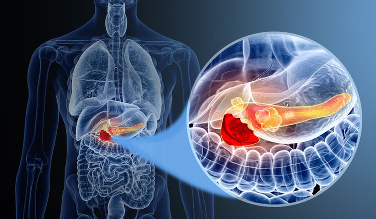 Pancreatic cancer